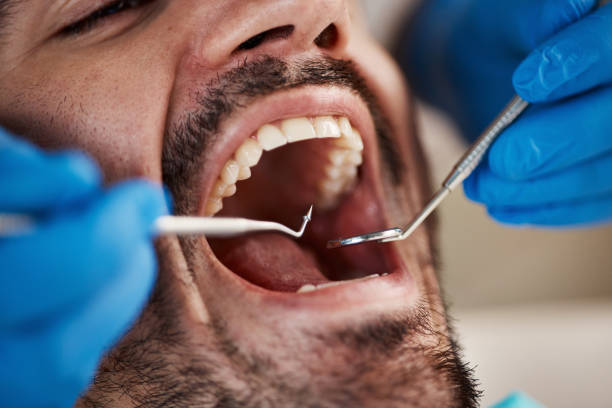 Best Emergency Wisdom Tooth Extraction in Mcpherson, KS